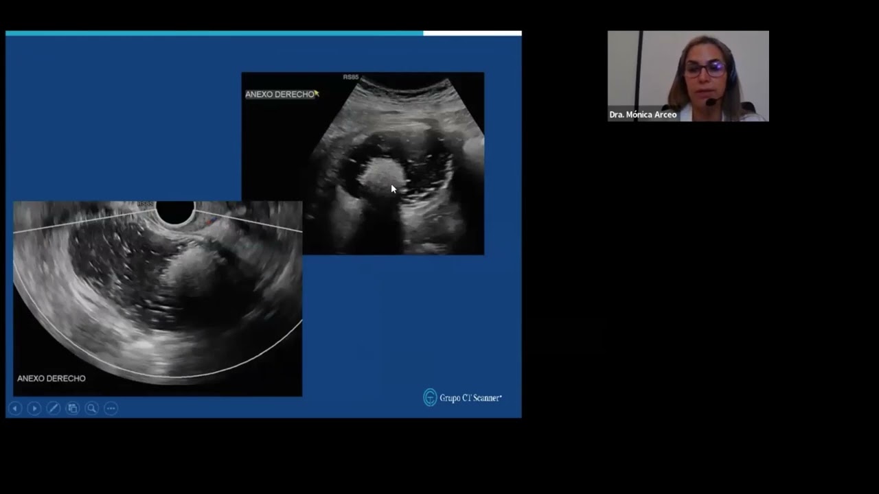 ❞𝗖𝗹𝗮𝘀𝗶𝗳𝗶𝗰𝗮𝗰𝗶𝗼́𝗻 𝗢-𝗥𝗔𝗗𝗦 𝗲𝗻 𝗽𝗮𝘁𝗼𝗹𝗼𝗴𝗶́𝗮 𝗼𝘃𝗮́𝗿𝗶𝗰𝗮❞ 𝗨𝗹𝘁𝗿𝗮𝘀𝗼𝗻𝗶𝗱𝗼 𝘆 𝗿𝗲𝘀𝗼𝗻𝗮𝗻𝗰𝗶𝗮 𝗺𝗮𝗴𝗻𝗲́𝘁𝗶𝗰𝗮