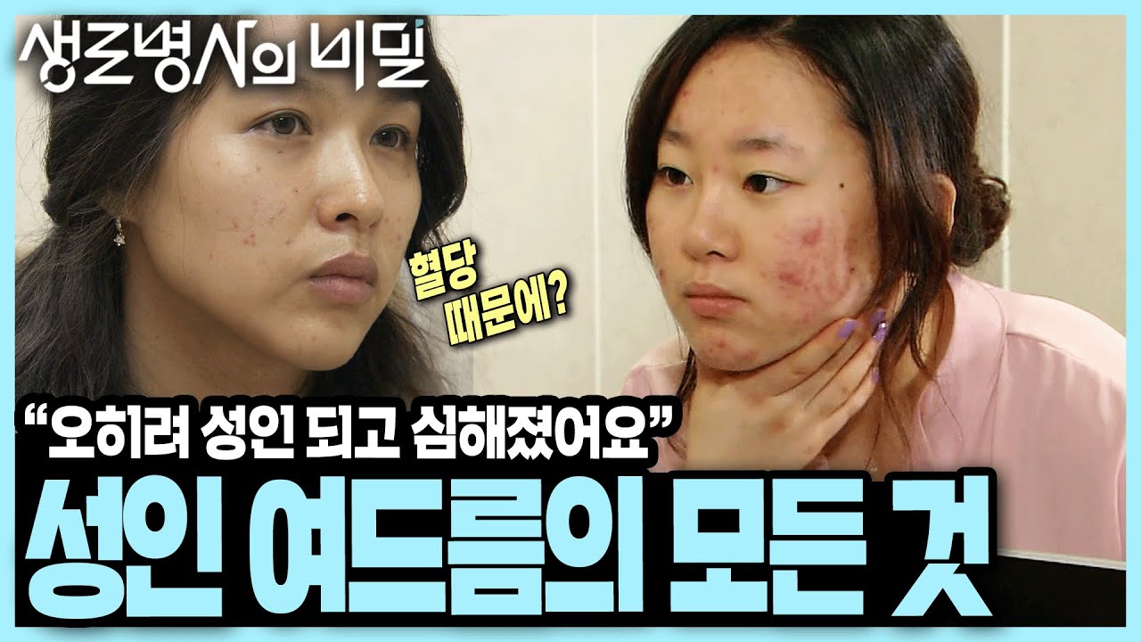 호르몬, 혈당, 스트레스... 성인여드름이 생기는 원인과 치료 방법 I KBS 120414 방송