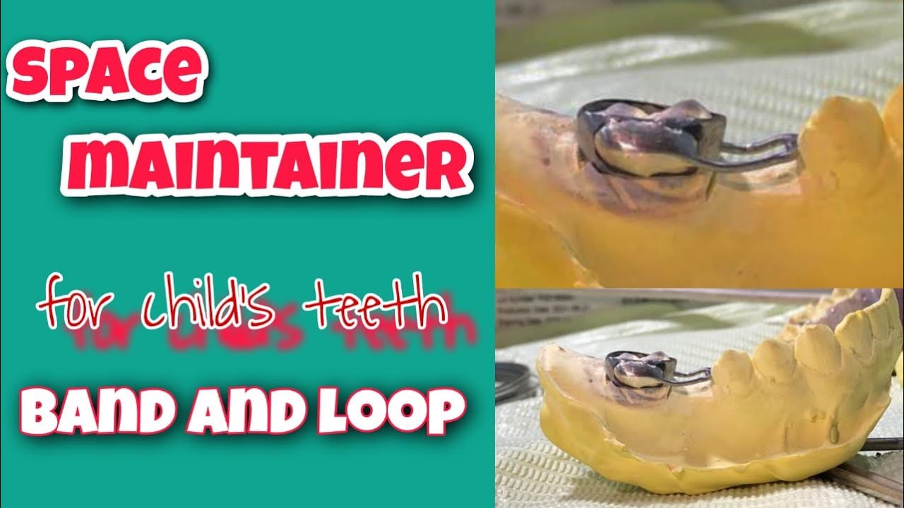 Space maintainer for child’s teeth ( band and loop ) #dental #dentaltechnology