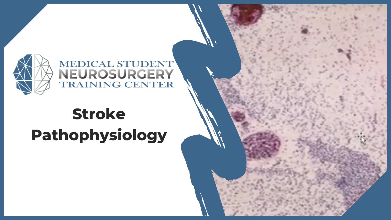 Stroke Pathophysiology
