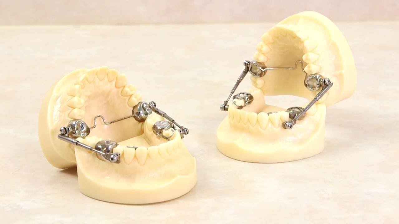 Making a Herbst Appliance
