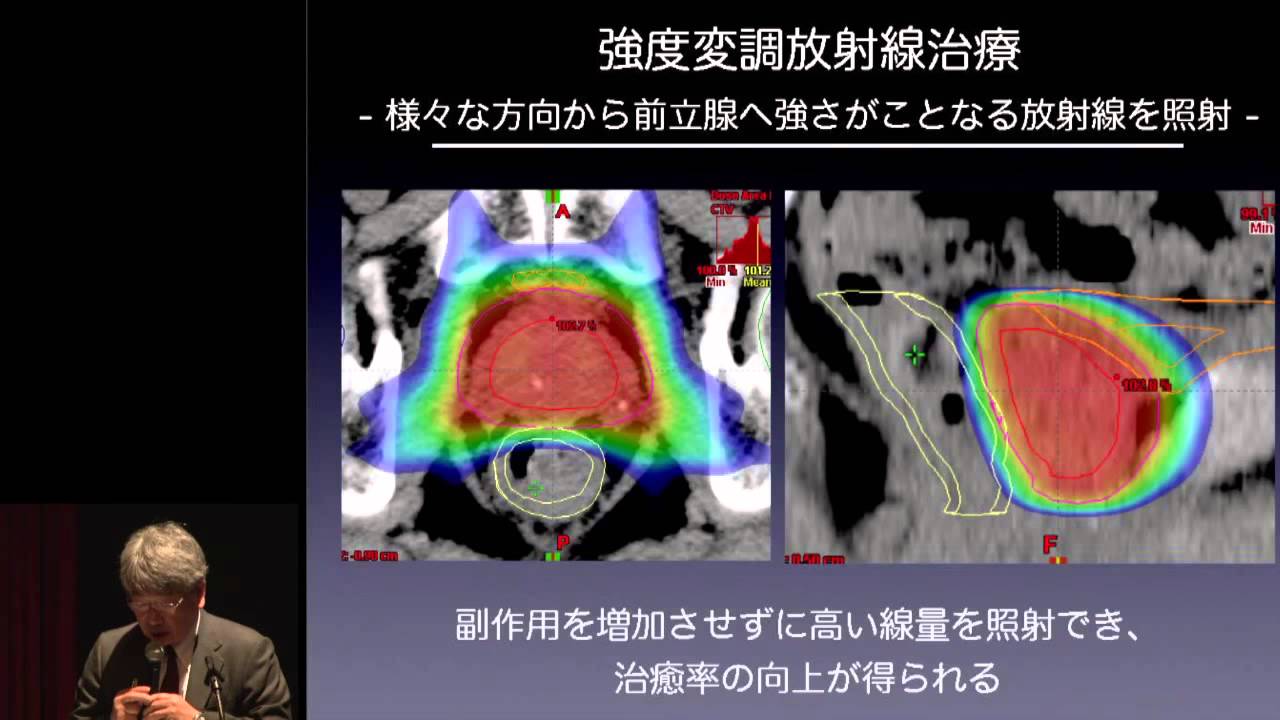 前立腺がんの放射線治療～IMRT、粒子線治療、小線源治療　秋元 哲夫