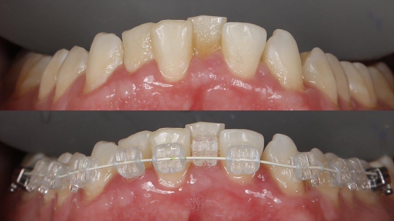 Montagem de Aparelho Dentário Inferior. Ortodontia: colagem de braquetes na arcada inferior.