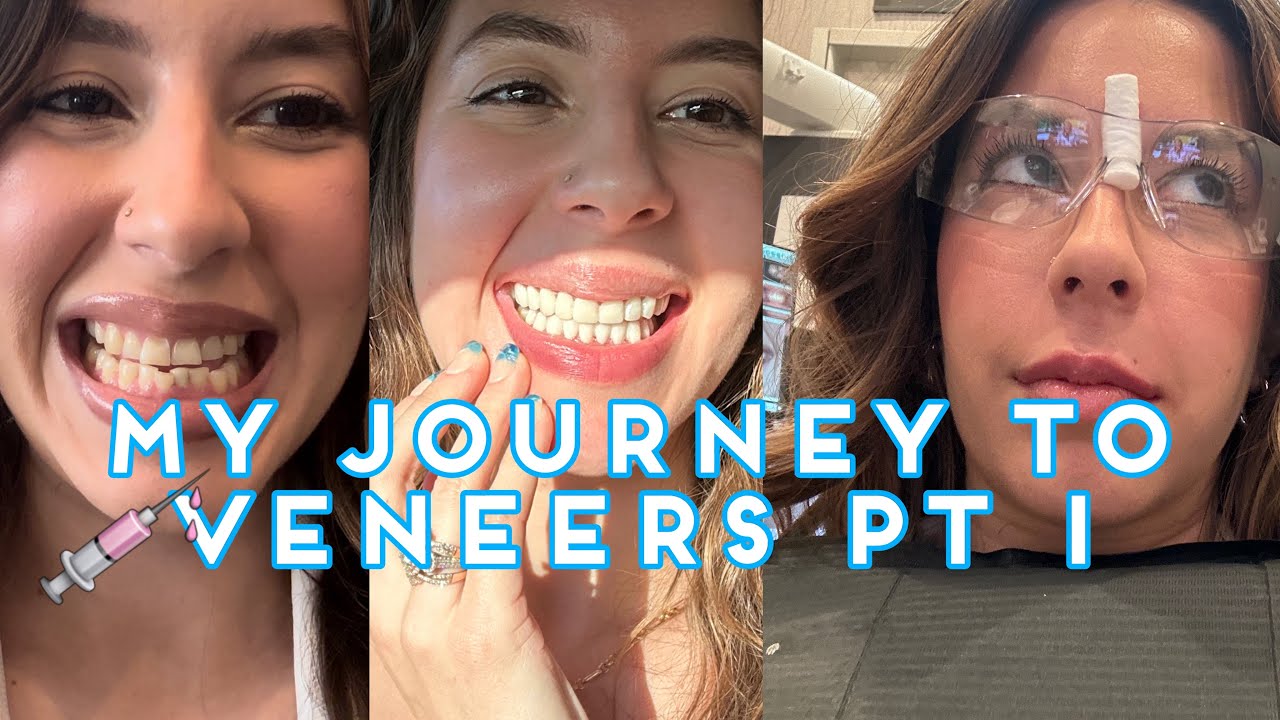 My journey to getting VENEERS!!! PT 1