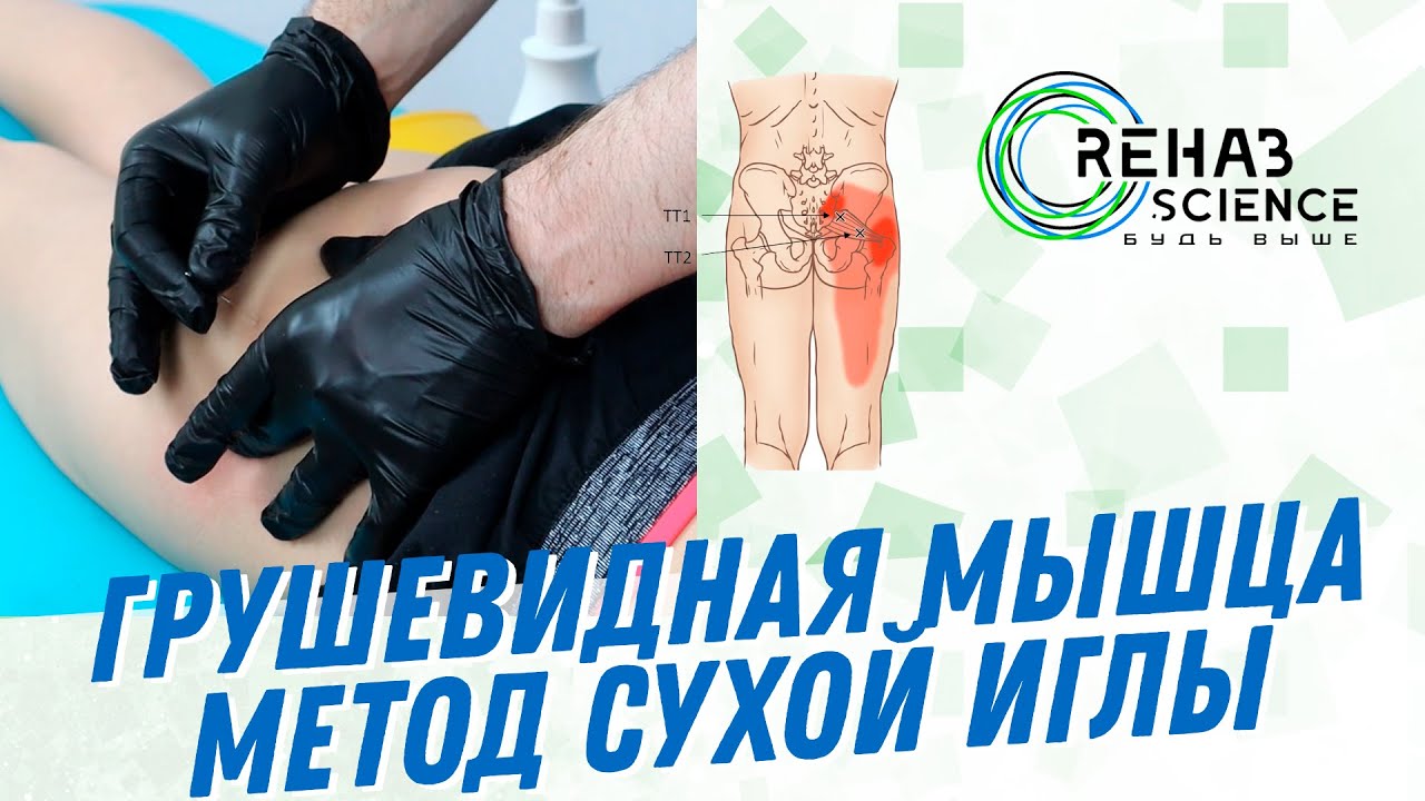 Грушевидная мышца, метод сухой иглы