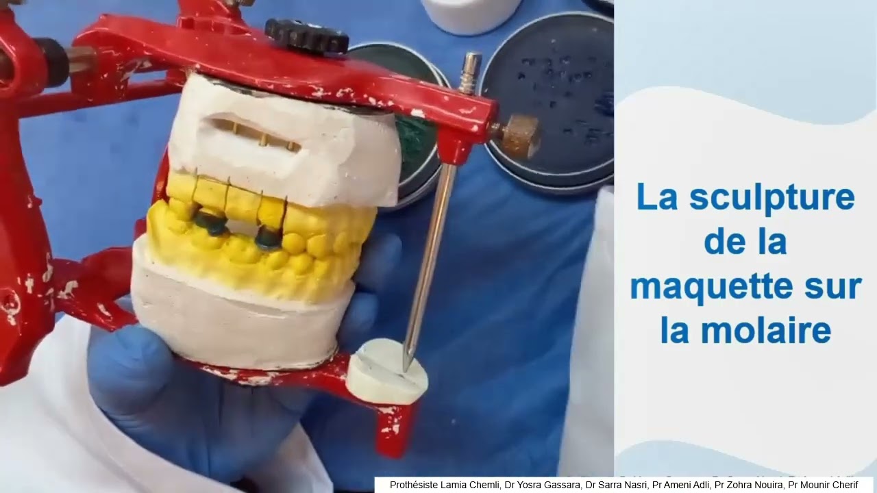 réalisation d'un maquette en cire d'un bridge métallo résineux à incrustation vestibulaire