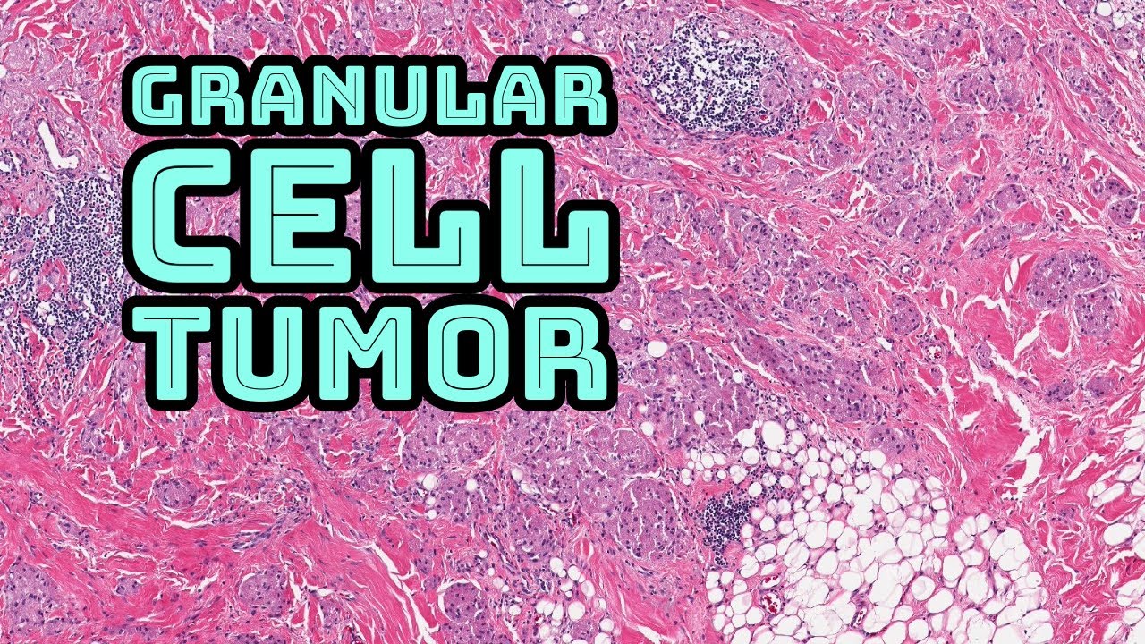 Granular cell tumor (benign nerve sheath tumor with granular cytoplasm) pathology dermatology