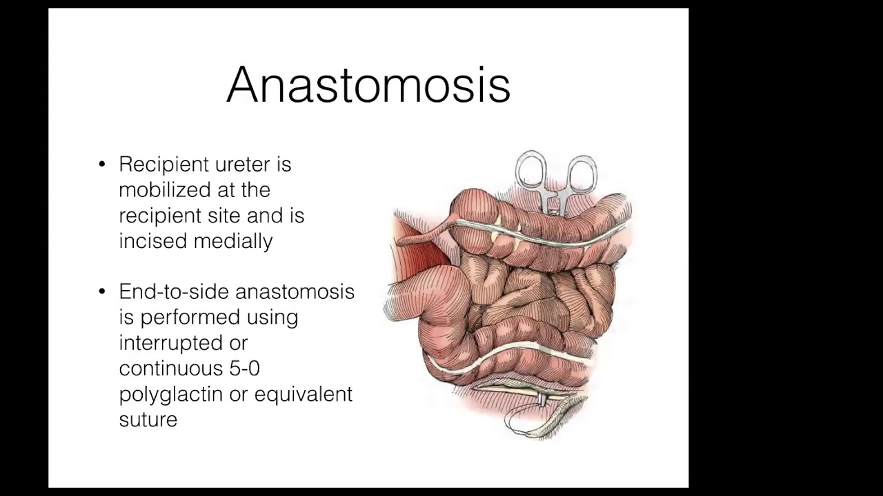 VMMC Surgical Procedures Revisited: Ureteral Reconstruction