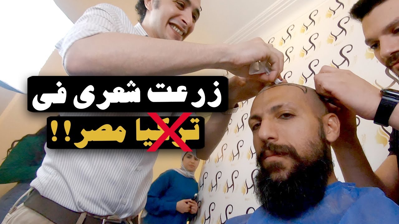 زراعة الشعر في مصر مش تركيا
