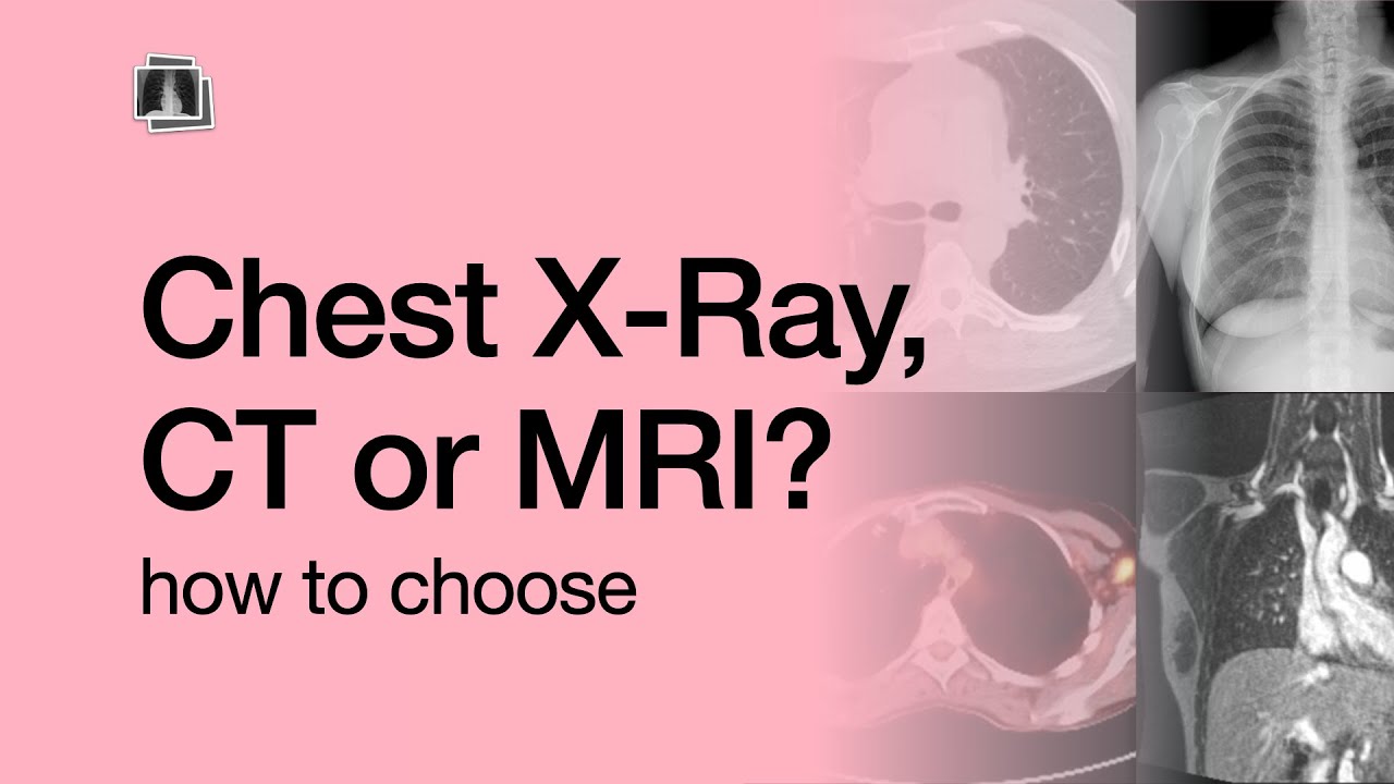Chest X-Ray, CT, or MRI?