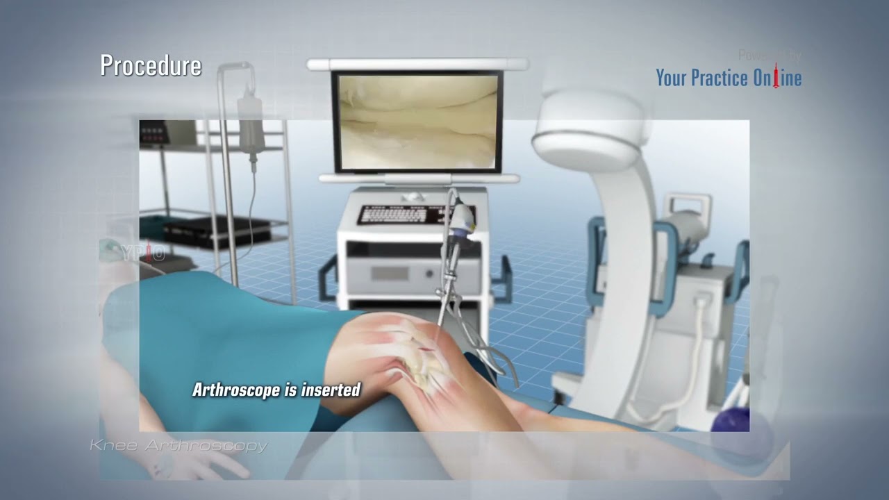 Knee arthroscopy