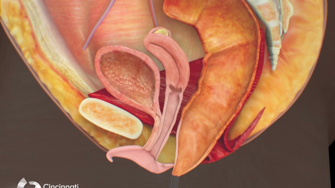 Surgical Treatment of Recto-Vestibular Fistula | Cincinnati Children's