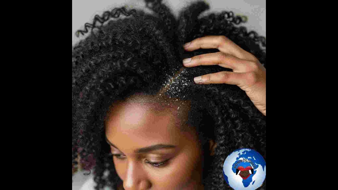 Duty of Memory-Three tips for effectively treating dandruff:Dandruff is a crusty growth that appears