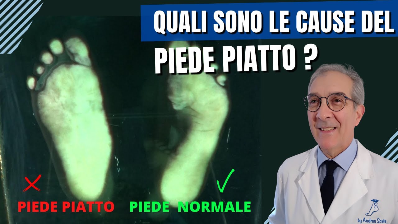 Piede piatto nell' adulto cos'è e come si cura | Che problemi comporta il piede piatto