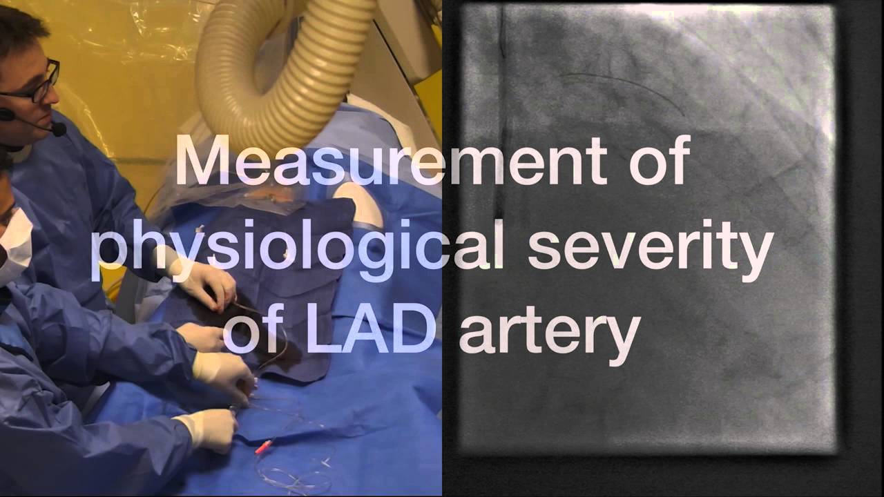 Application of iFR in complex 3vd lesion assessment