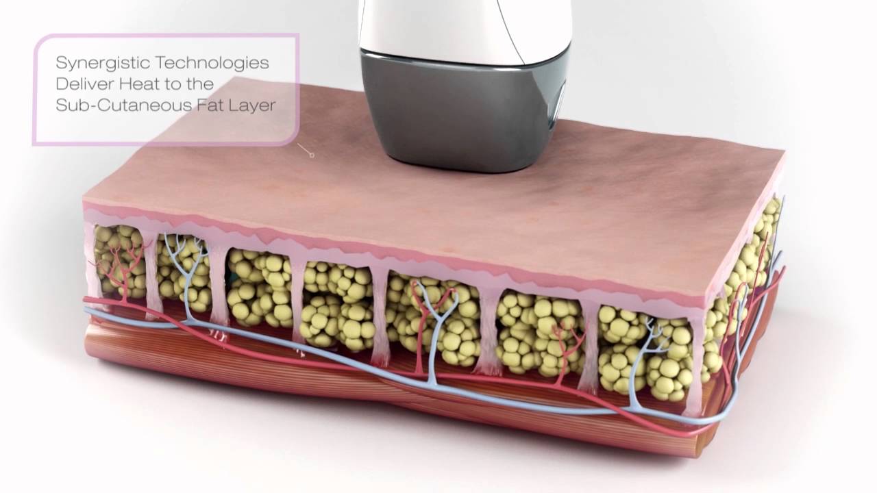 Velashape 3 - Fast & Easy way to Slim Abdomen, Thighs, Arms & Neck