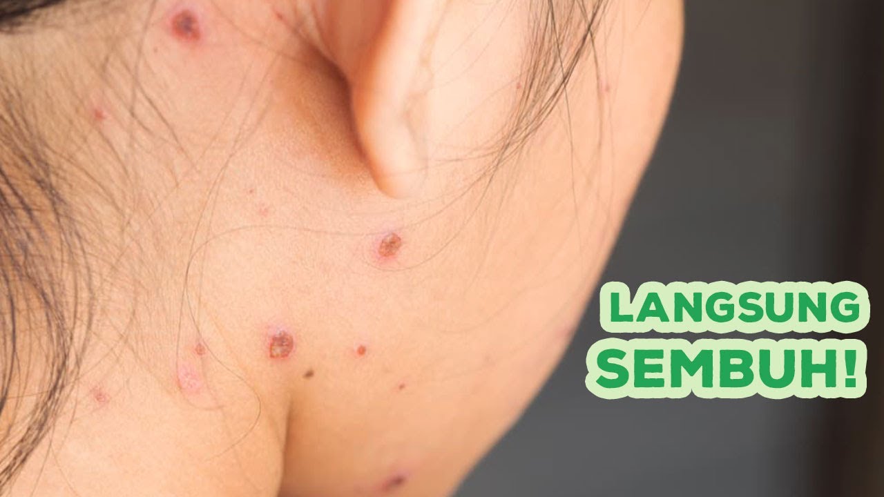 Inilah Cara Mengatasi Cacar Air Agar Tidak Menyebar