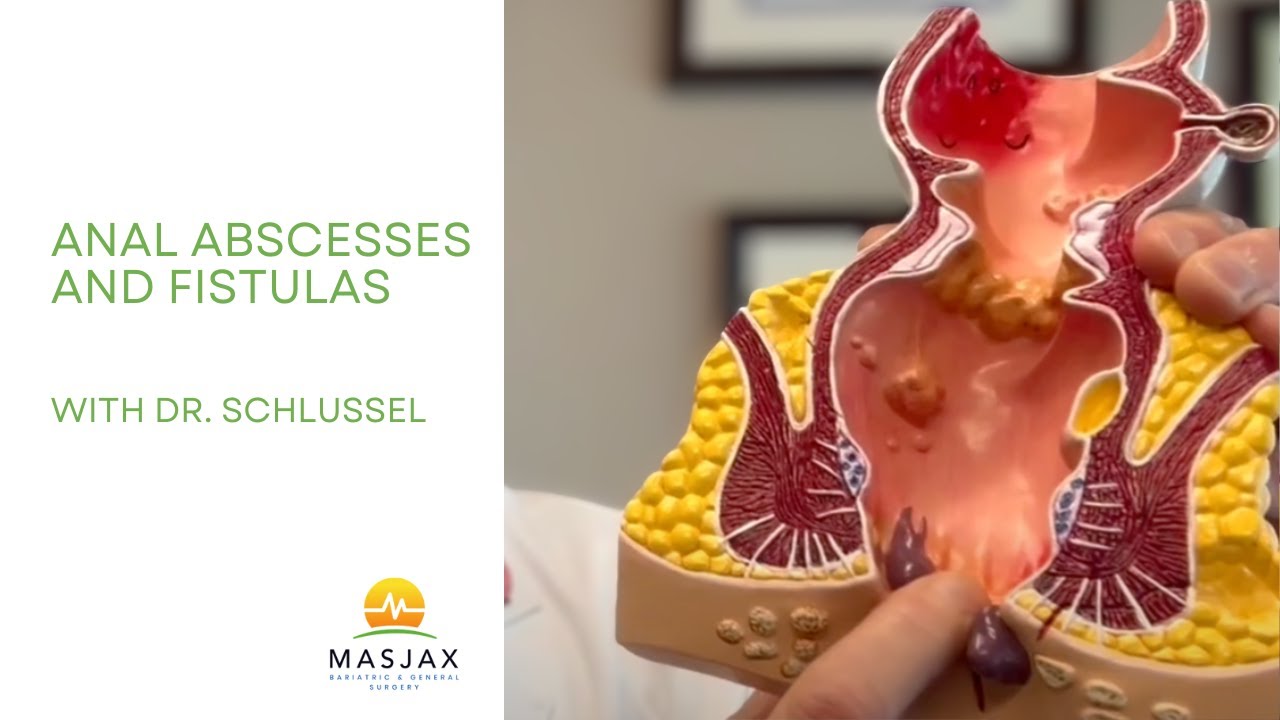 🔴 Painful Anal Abscess or Fistula? Here&rsquo;s What You Need to Know