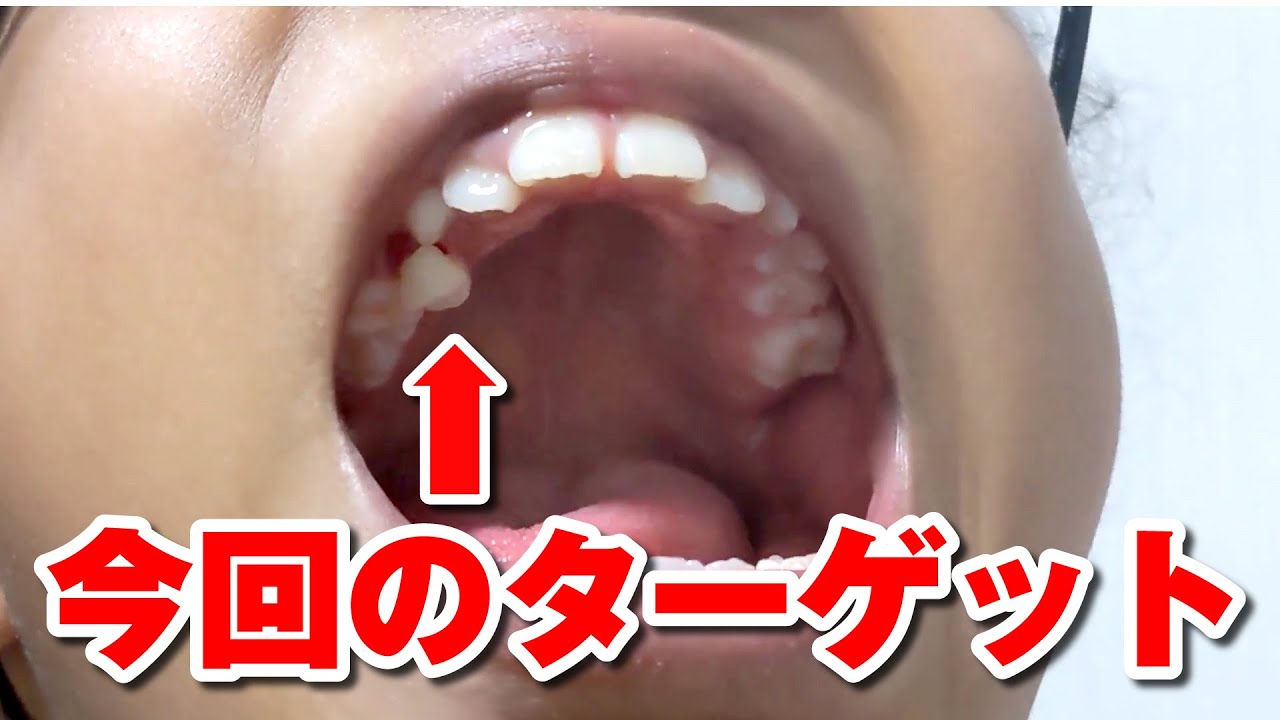 自分で歯をねじり取る、小５女子の挑戦！