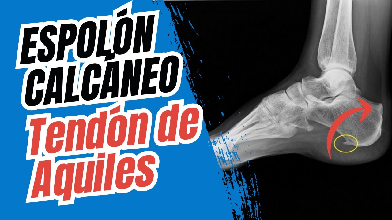 ESPOL&Oacute;N CALC&Aacute;NEO EN EL TEND&Oacute;N DE AQUILES ✅