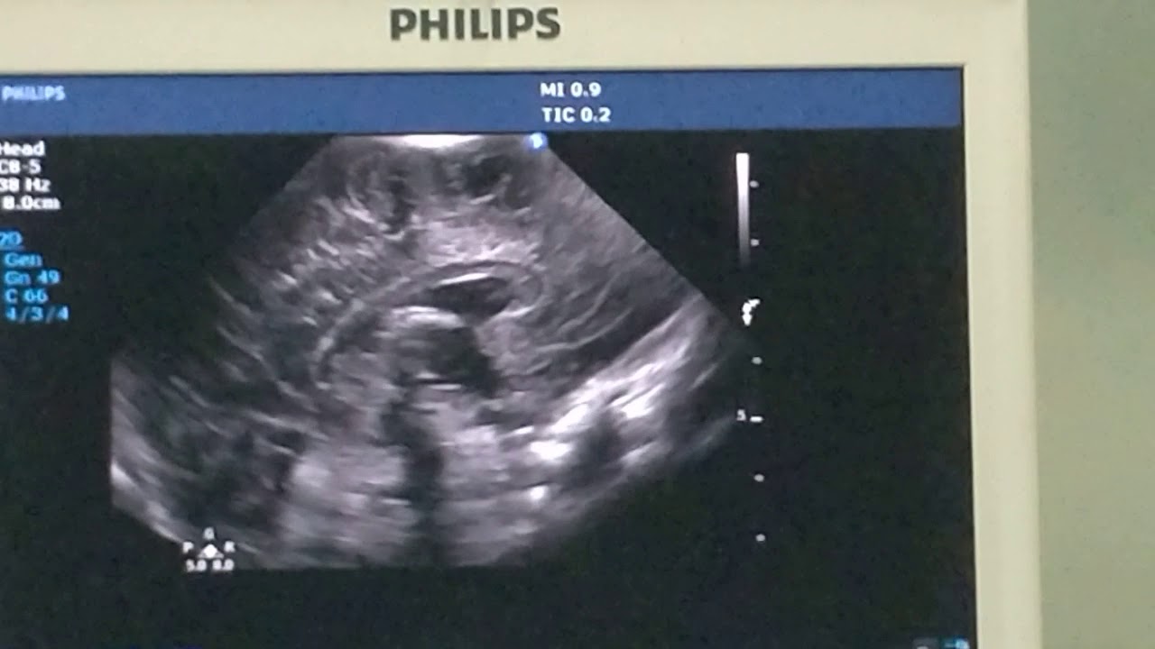Neonatal brain ultrasound