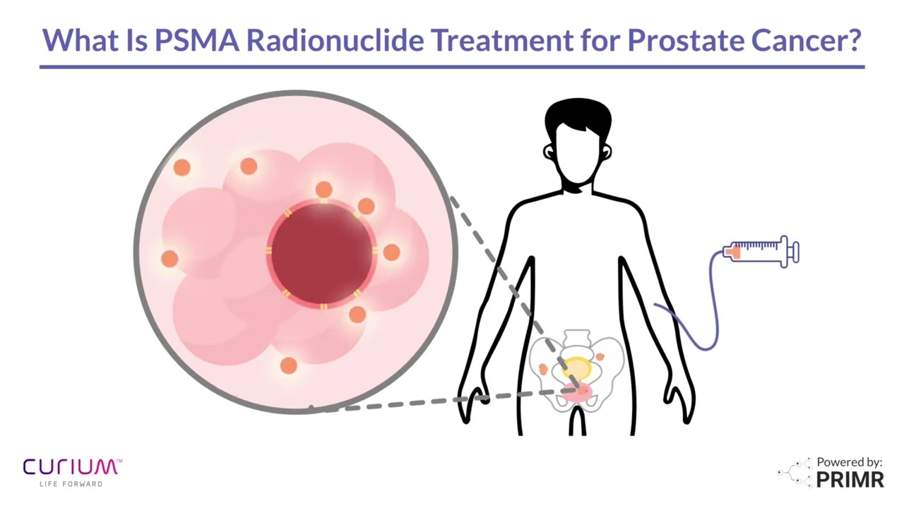 PSMA Prostate Cancer Treatment | Radioligand Therapy (RLT)