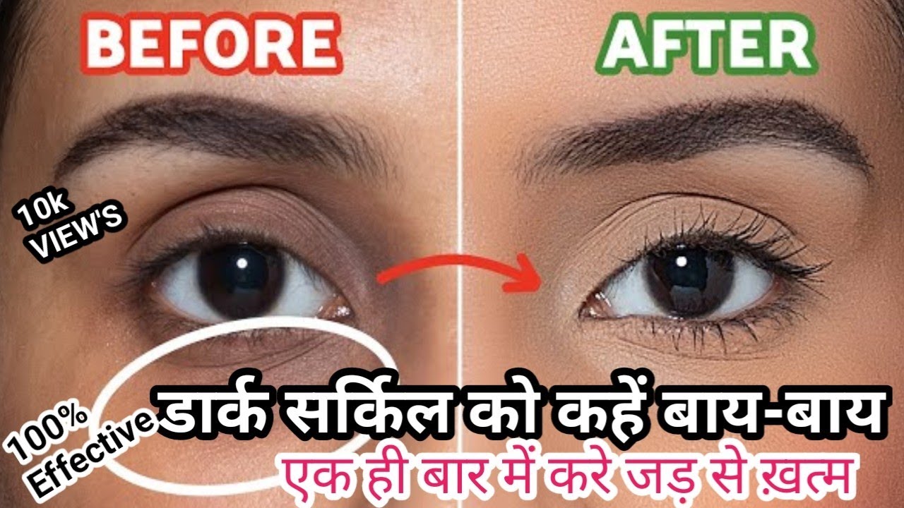 Dark circles एक ही बार में करे  जड से ख़त्म#darkcircles #homemade #facepacke #skincare