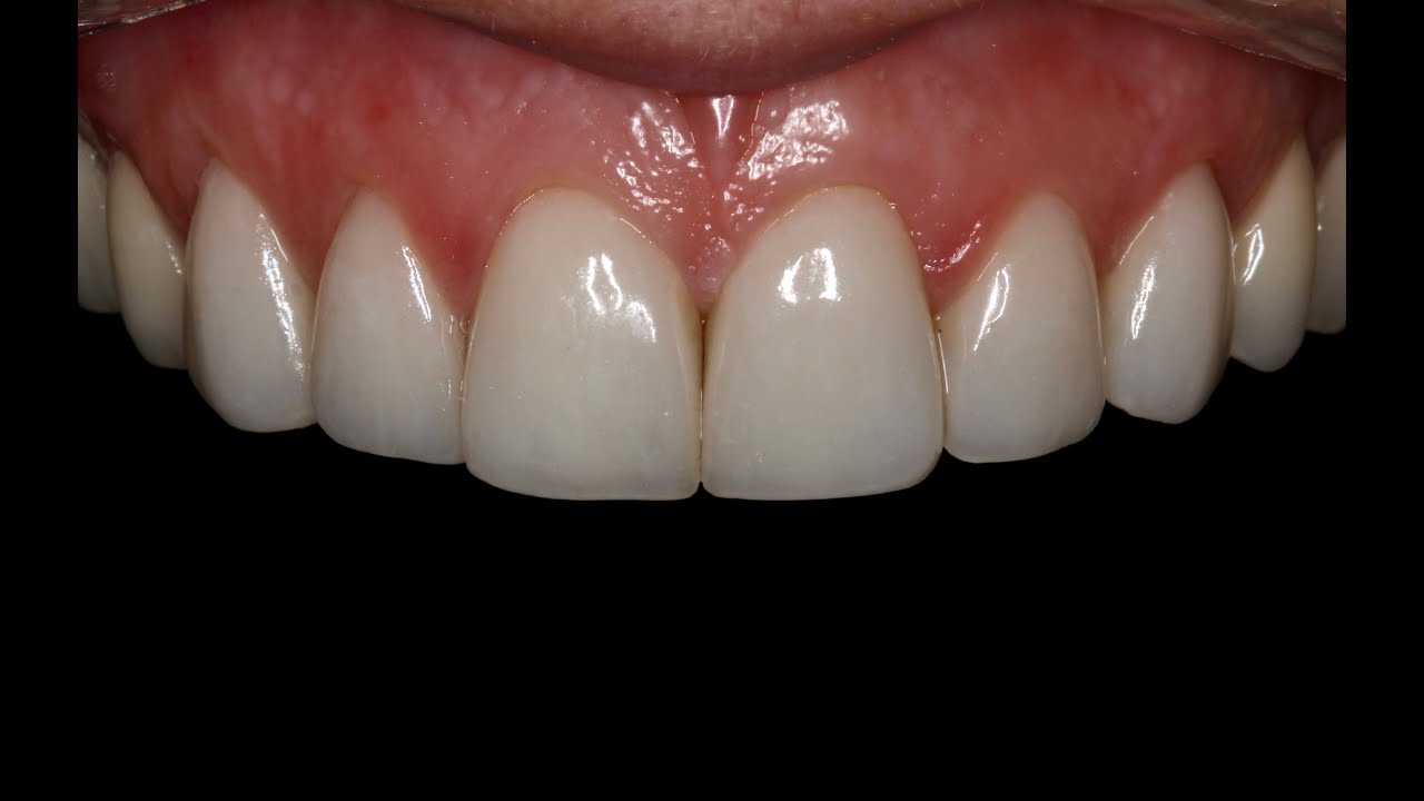 Lamina simantasyonu - Cementation of Laminate veneers