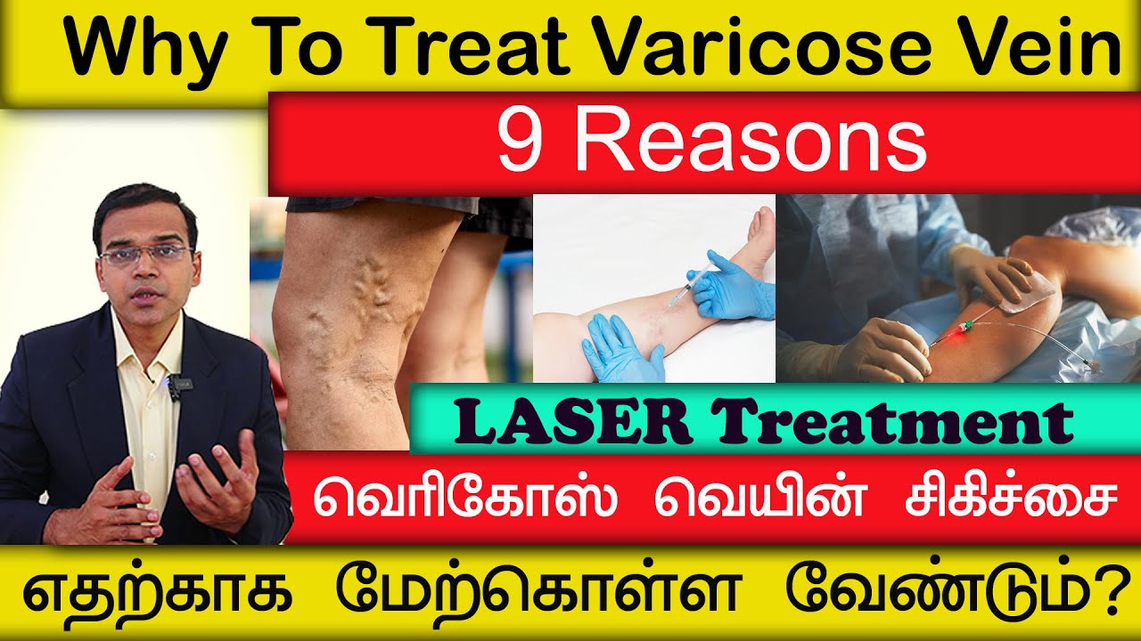 Why To Treat Varicose Vein? 9 Reasons  வெரிகோஸ் வெயின் சிகிச்சை எதற்காக மேற்கொள்ள வேண்டும்?