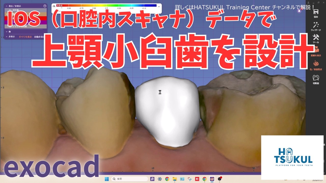 #321　exocad設計　IOS（口腔内スキャナ）データで上顎小臼歯を設計！（解説なし版）