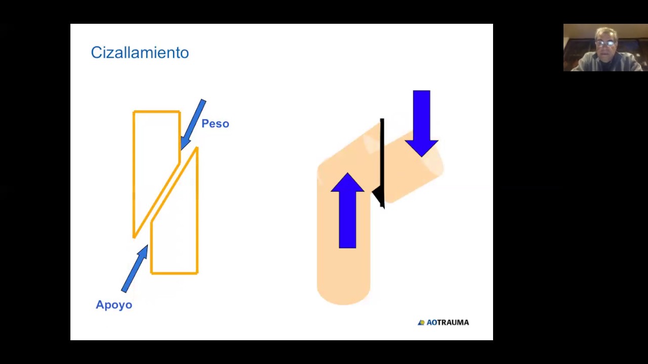 Principios biomec&aacute;nicos para la osteosintesis