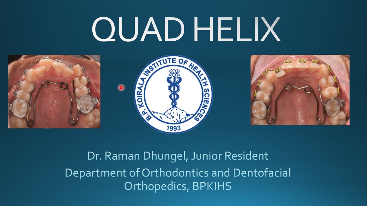 Аппарат Quad Helix в ортодонтии