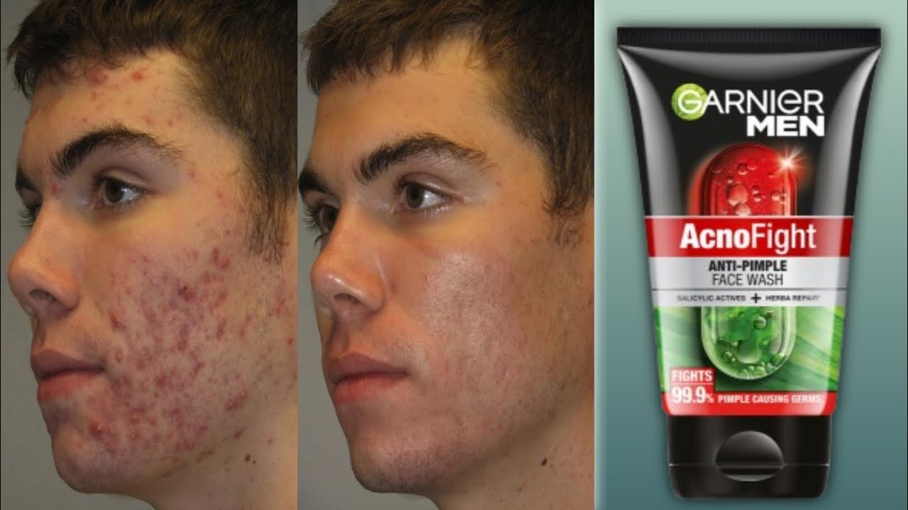 Acno fight face wash full information 