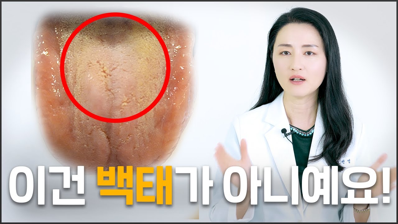 치과의사가 알려주는 백태 한번에 없애는 방법!!ㅣ구취 끝~😊
