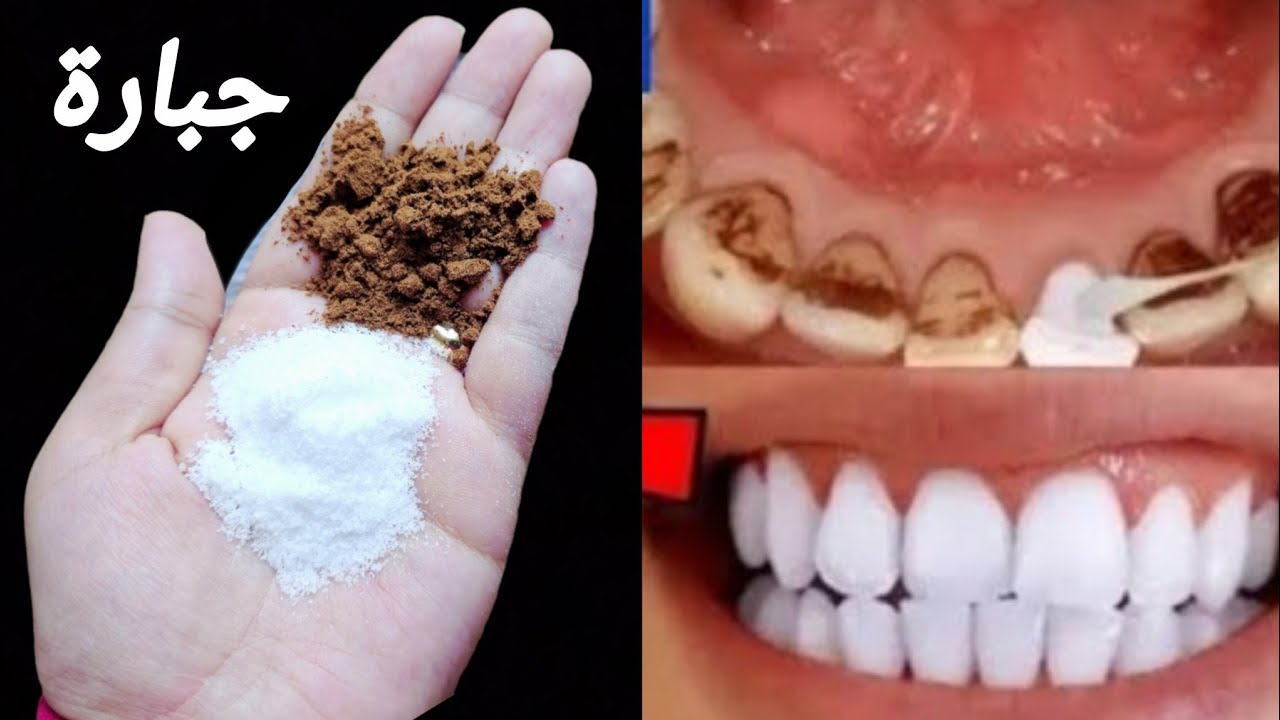اقسم بالله ‼️ لن تحتاج للذهاب لطبيب الأسنان ‼️ لتبييض الأسنان واسقاط الجير ‼️ سيسقط لوحده 