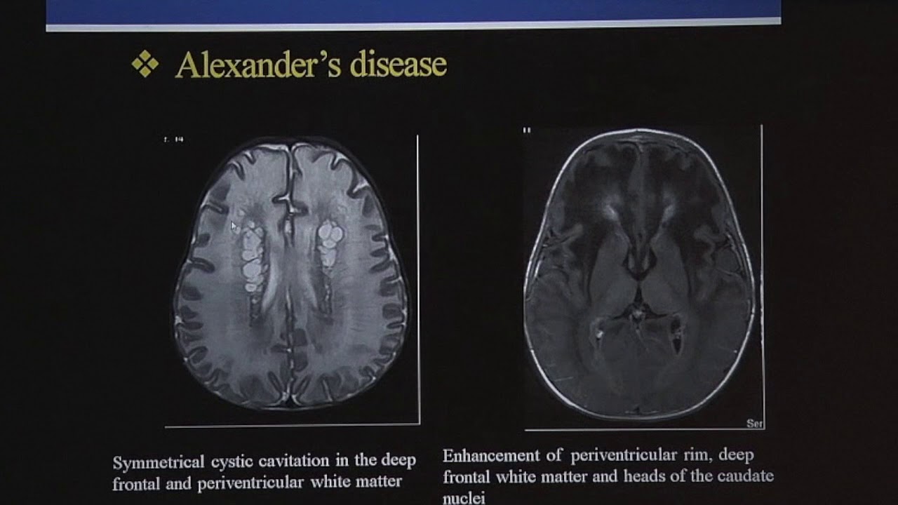 TMT: MRI in Pediatric White Matter Diseases - IV, by Dr Deepak Patkar