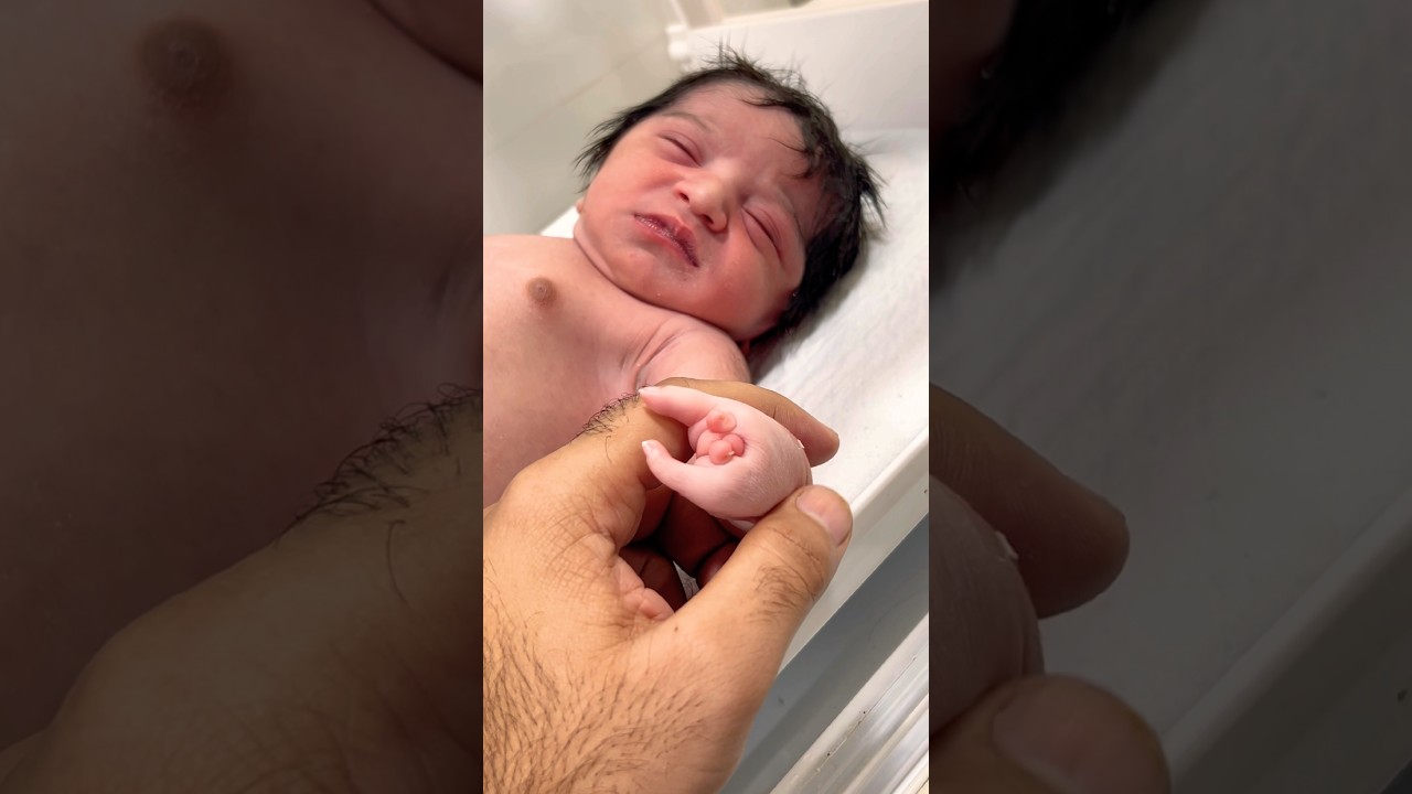 Baby’s Unique Hands — Rare Birth Condition: Baby Born with Ectrodactyly!”