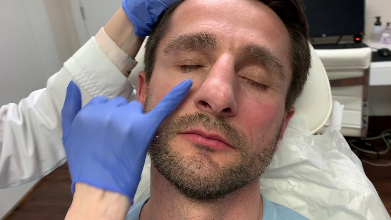 RADIESSE® filler - cheek augmentation - South Florida Center for Cosmetic Surgery