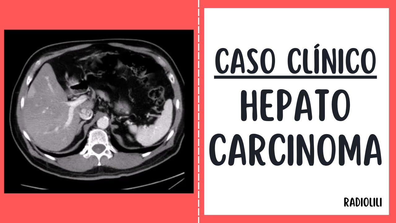 Hepatocarcinoma: Caso Clínico Radiológico.