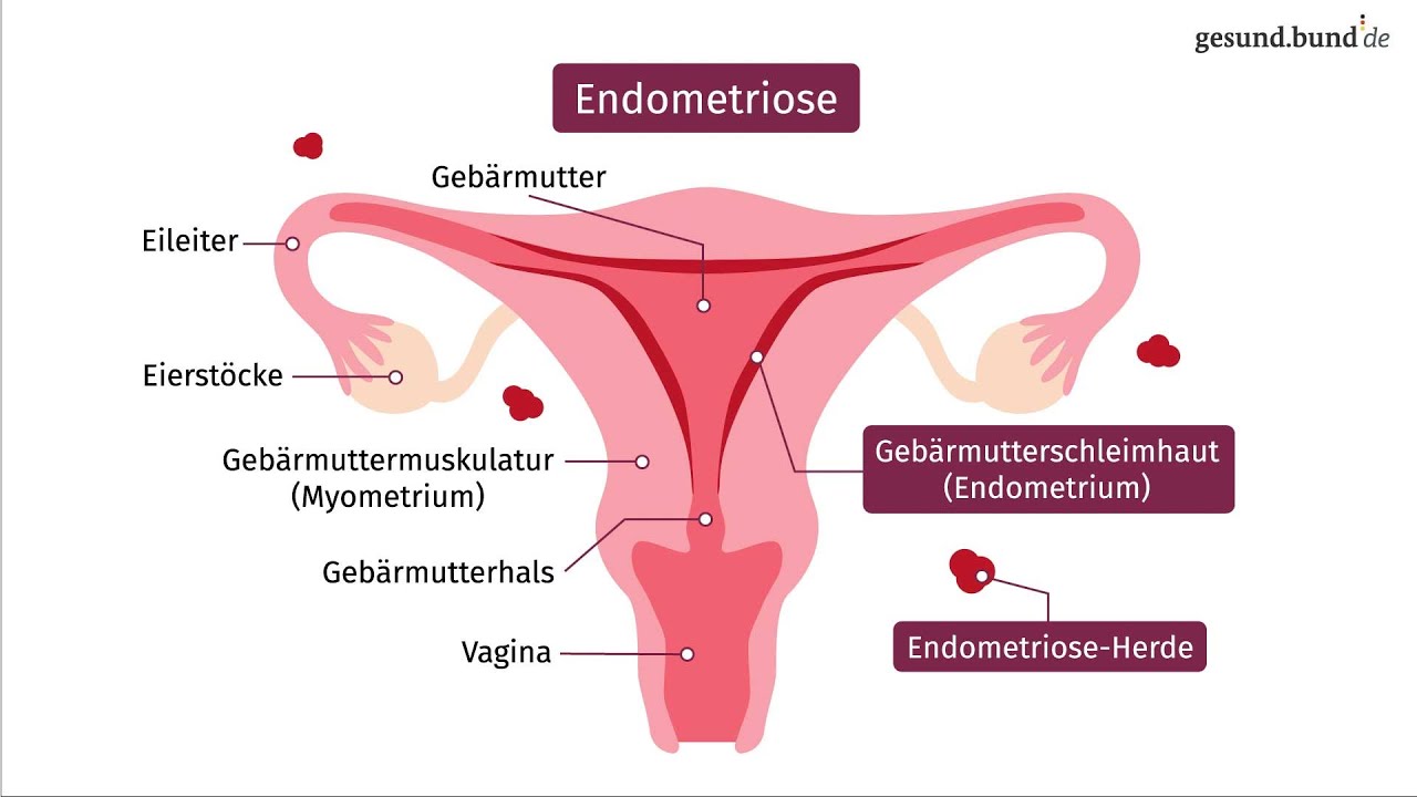 Was ist Endometriose und wie entsteht sie?