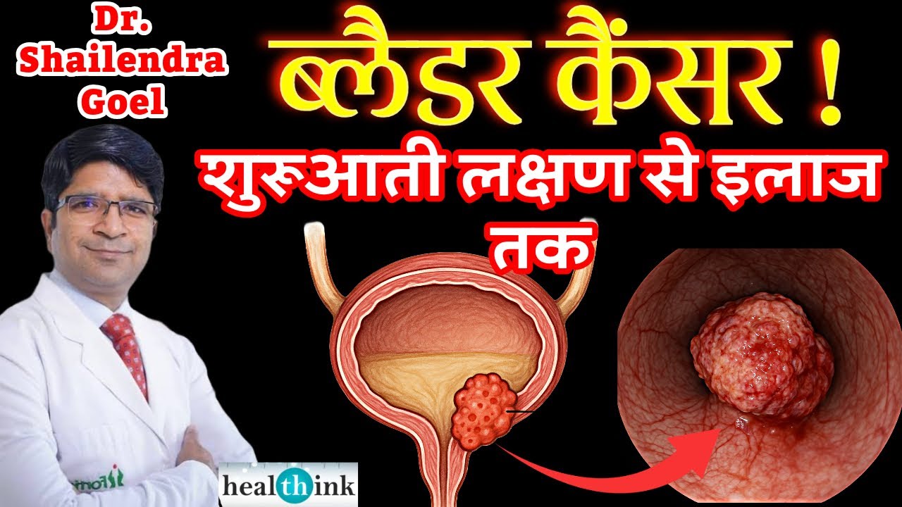 Bladder cancer symptoms and treatment ।  ब्लाडर कैंसर के लक्षण और इलाज #bladdercancer