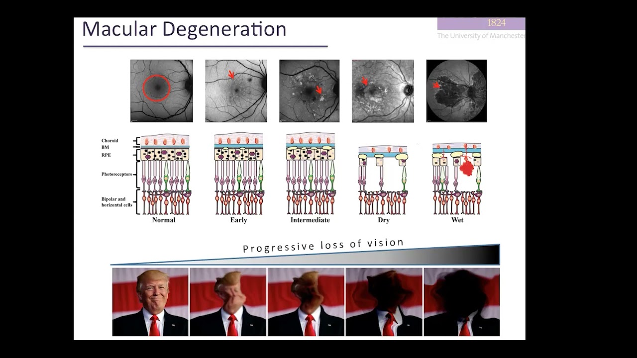 Early onset AMD with Rachel Taylor