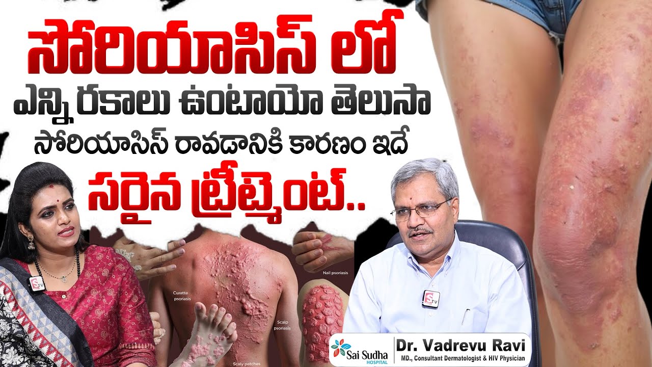 Psoriasis Causes and Symptoms in Telugu | Skin Disease Solution | Dr. Vadrevu Ravi | SumanTv