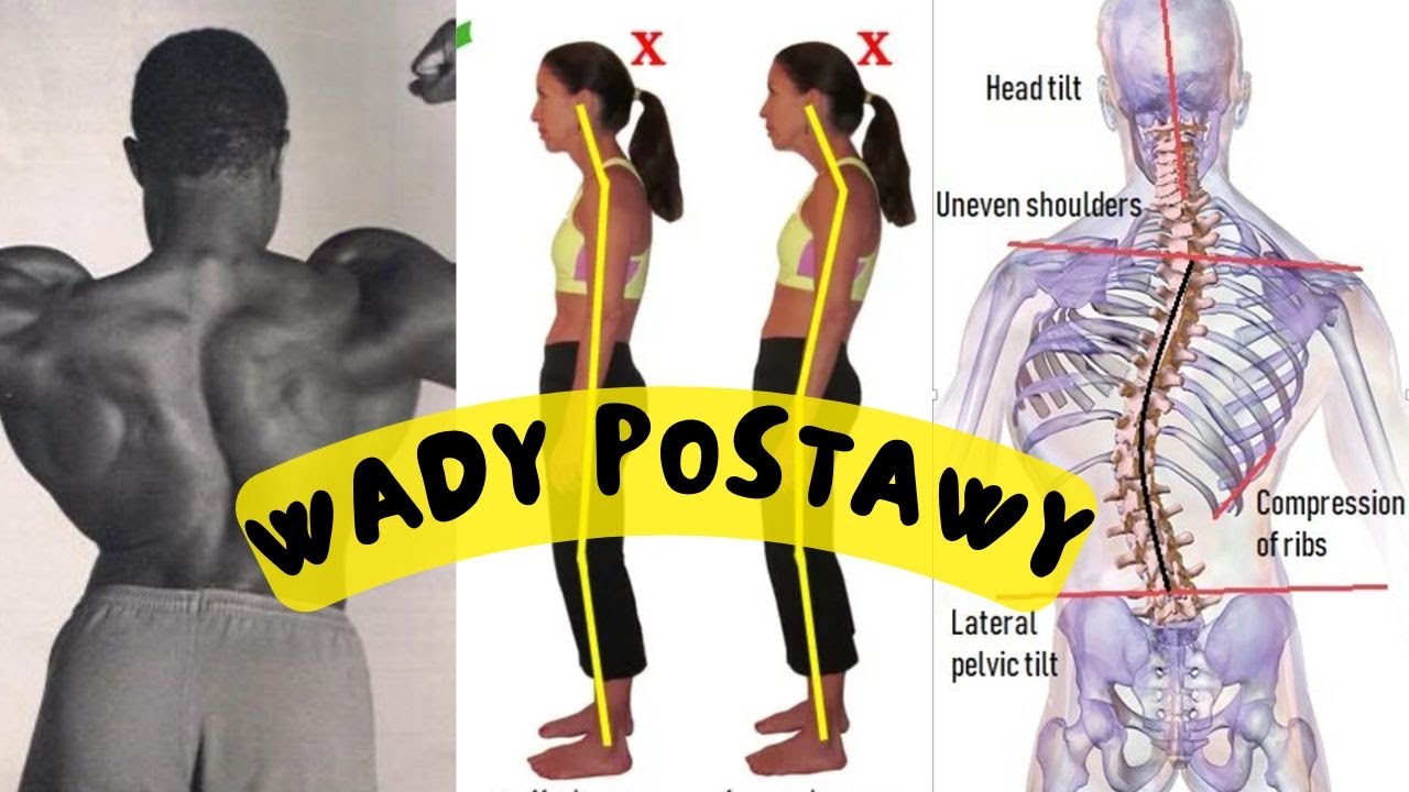Postawa ciała. Jak ją skorygować? Kompleksowe podejście.