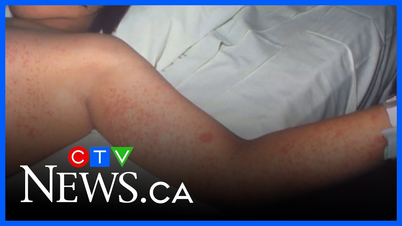 'The government is failing' when it comes to measles: doctor | Alberta Primetime