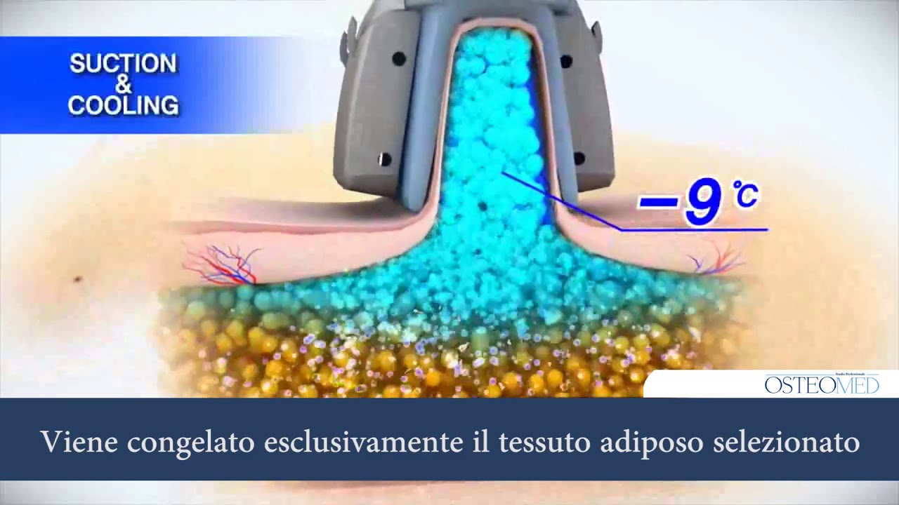 Studio OSTEOMED   CRIOLIPOLISI Riduzione reale delle adiposit&agrave; localizzate dimagrimento localizzato