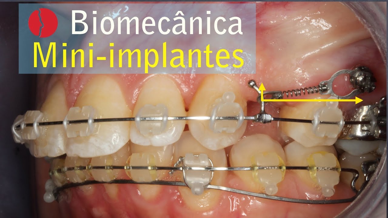 mini implante biomecânica TAD ancoragem esquelética biomechaniccs