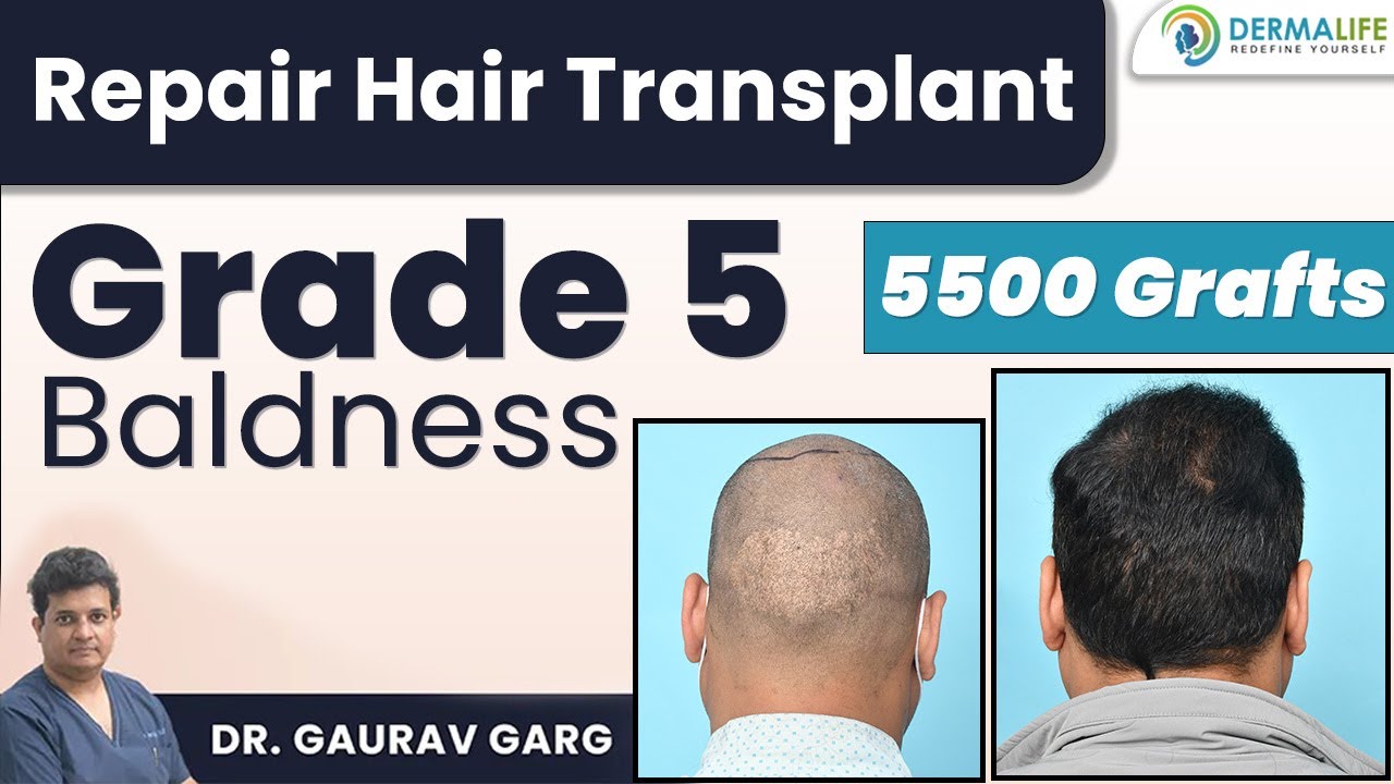 Repair Hair Transplant in Grade 5 Baldness | 5500 Grafts | Dr. Gaurav Garg Dermalife, Delhi