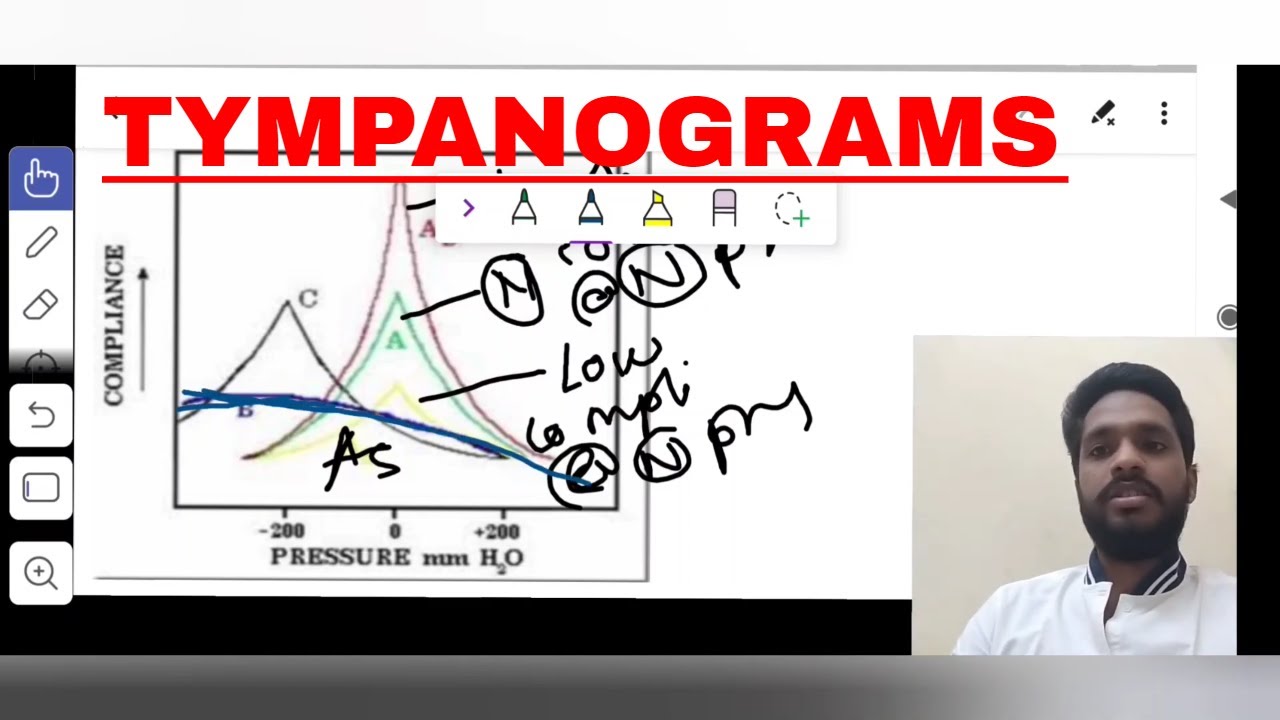 Tympanograms (Hinglish version)