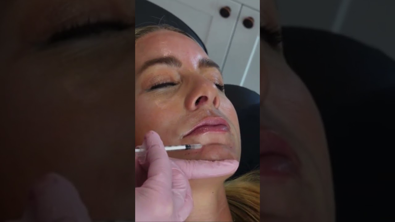 Natural Lip Filler Technique for Smooth, Even Results